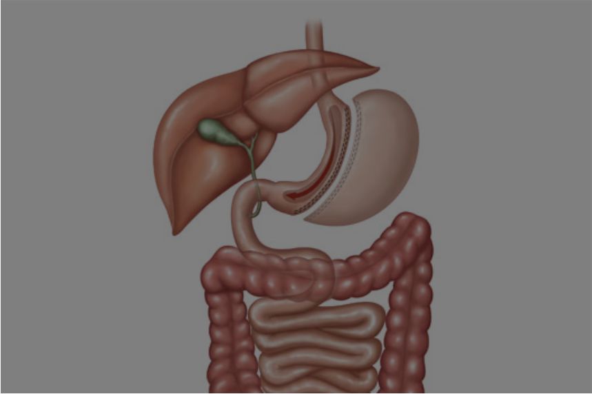 Cirurgia Refluxo Hérnia de Hiato