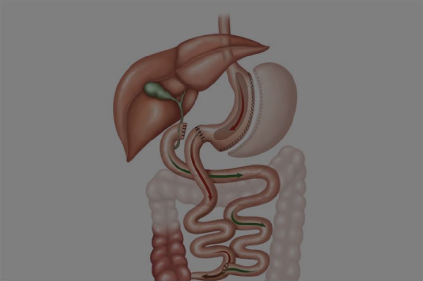 Cirurgia Videolaparacópica